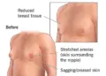 How To Get Gynecomastia Surgery Covered By Insurance In 2024