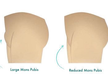 FUPA (Fatty Upper Pubic Areas) – How to Get Rid of It Naturally & Effectively